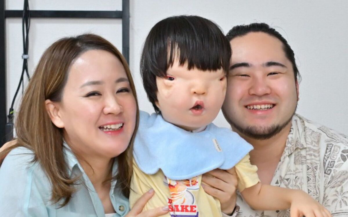「おでこや頬の骨が、ない」“世界でも珍しい障害”を持つ3歳男児『おもちくん』が経験してきた“数々の手術”と、両親の想い「あなたがいて幸せって、伝えたい」