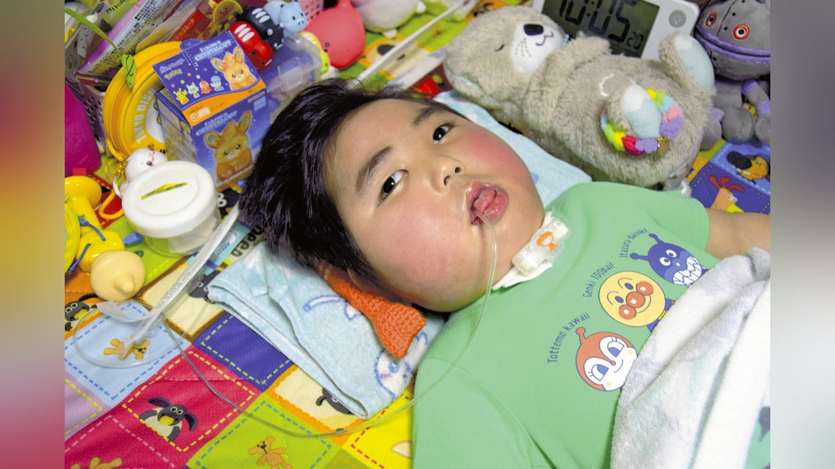 保育施設で喉にバナナを詰まらせた１歳男児、２年過ぎても動けず意思疎通もできず…体重は２倍に