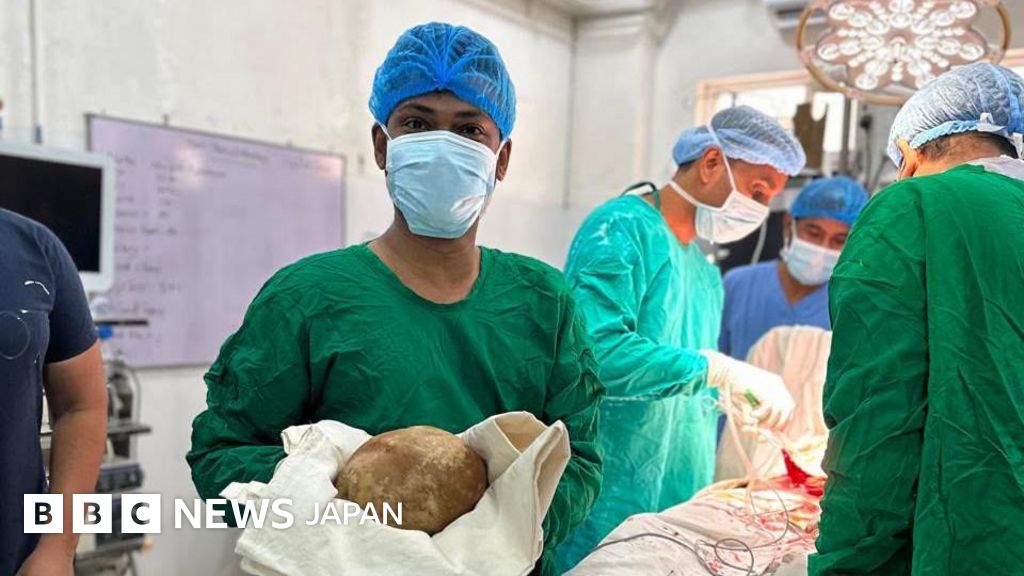 スリランカで男性の膀胱から重さ3.1キロの結石摘出 記録的大きさの可能性