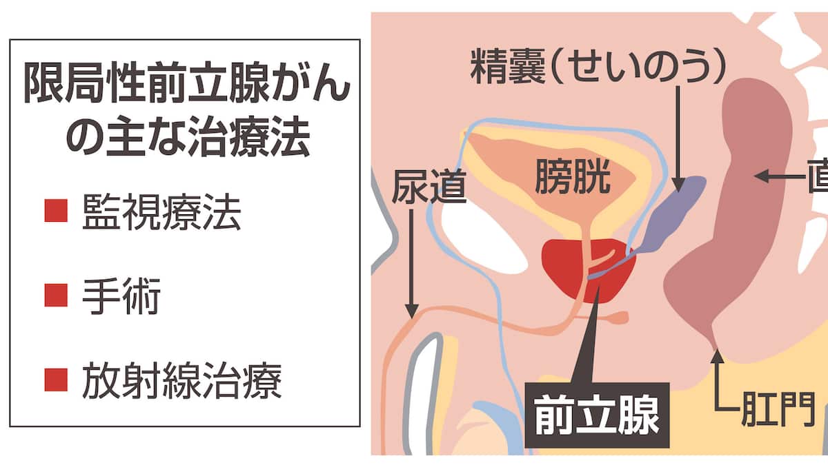 男性で最も多い「前立腺がん」 その後の生活見据えて治療法を選んで