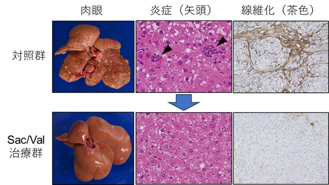 心不全薬「アンジオテンシン受容体ネプリライシン阻害薬」が肝臓病「MASH」の線維化・発がんを抑制｜医学部・学会情報｜医・歯学部を知る