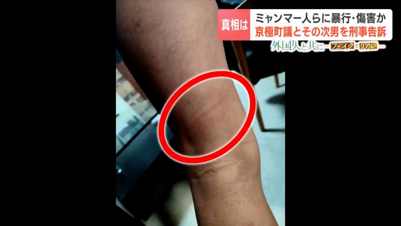 特定技能のミャンマー人らに暴行か 町議らを傷害容疑などで刑事告訴 20歳男性「怖かった、痛かった」町長は「できることは特にない」役場の不対応に懸念の声 北海道京極町