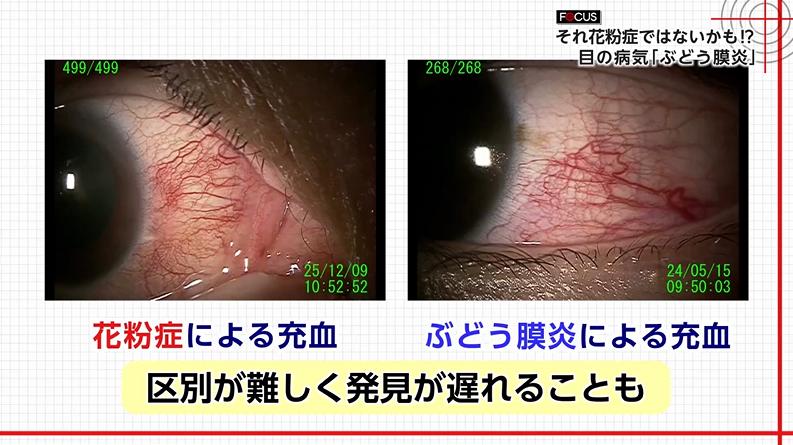 失明の恐れも…『花粉症と酷似』年間5万人発症の“目の病気”「ぶどう膜炎」 「見分け方」と「早期受診の重要性」を専門医に聞いた