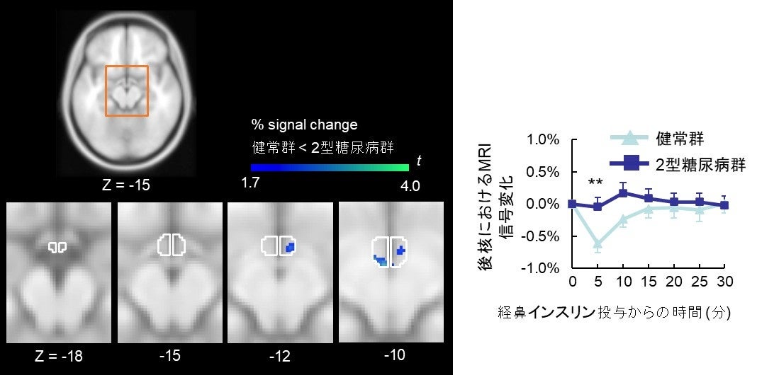 2型糖尿病における「脳のインスリン抵抗性」は視床下部後核に局在することを解明