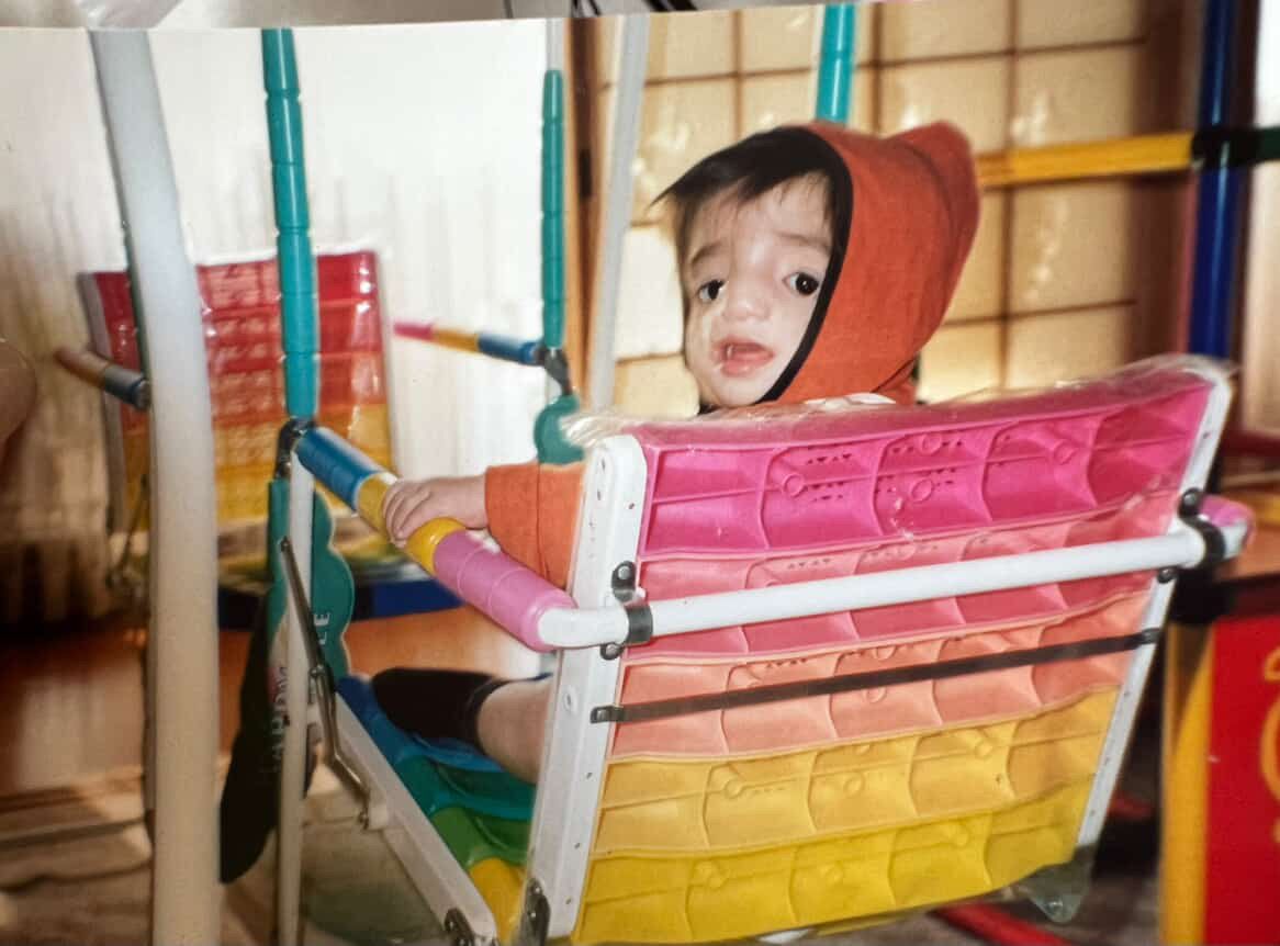 「“見ちゃダメ”と子どもの手を引く親も…」頬や顎の骨、耳がなく生まれたトリーチャー・コリンズ症候群の女性（31）が語る、複雑な本音（文春オンライン）