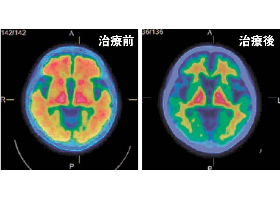 認知症の原因「完全除去」 進行抑制効果を確認 ドナネマブ投与