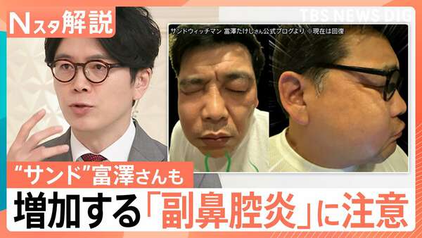 “顔の腫れ”に“視力低下”のおそれも…増加する「副鼻腔炎」 花粉のピークが過ぎた季節に注意したい“鼻トラブル”【Nスタ解説】