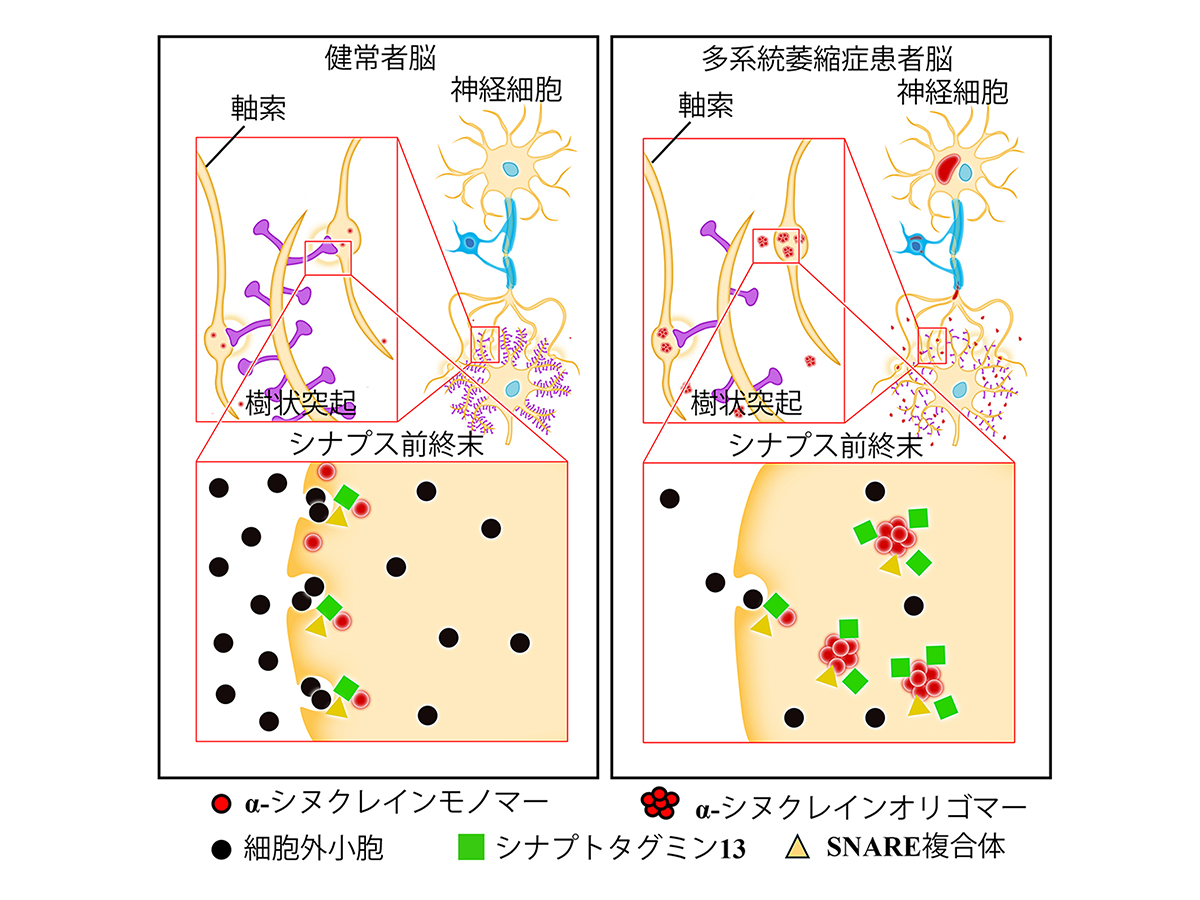 レヴィ小体型認知症や多系統萎縮症における認知症の成因を発見