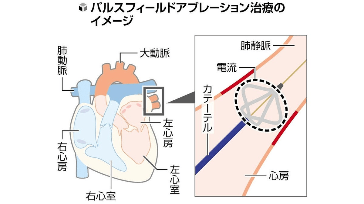 心房細動に高電圧電流用いた新治療、神奈川県内で開始…従来の手法より低リスク・短時間