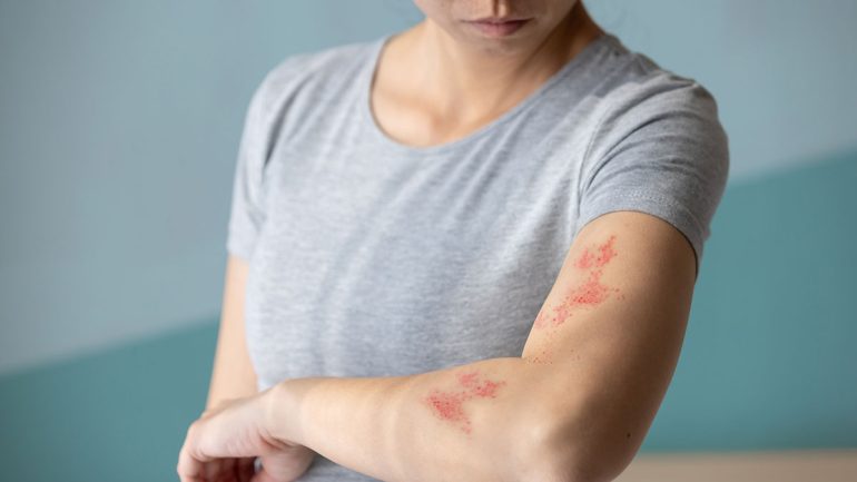 帯状疱疹ワクチンの定期接種がスタート、高齢者対象でも多くの自治体で助成あり｜@DIME アットダイム
